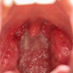 White spots on tonsils