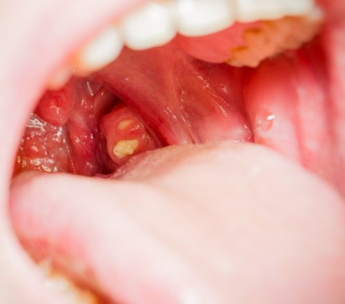 White spots on tonsils : Tonsillitis