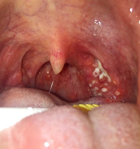 White spots on tonsils : Chronic tonsillitis