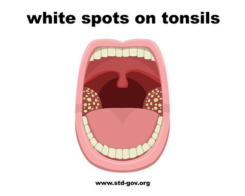 back of throat white but not tonsils