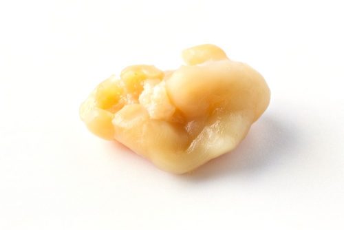 White spots on tonsils : Close up tonsillolith