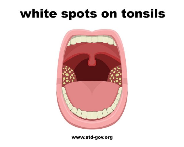 White spots on tonsils