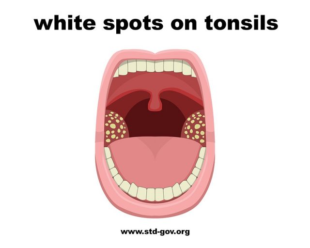 White spots on tonsils 