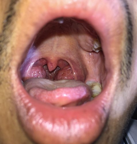 White spots on tonsils 