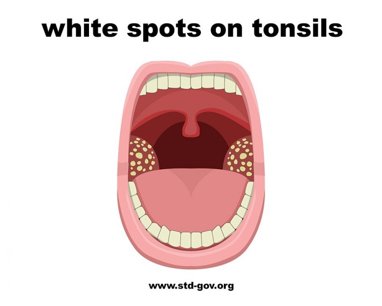 White Spots On Tonsils Treatment