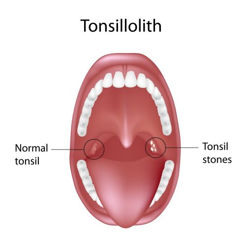 White spots on tonsils : Tonsil stones