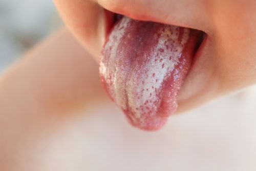 White spots on tonsils : Oral thrush