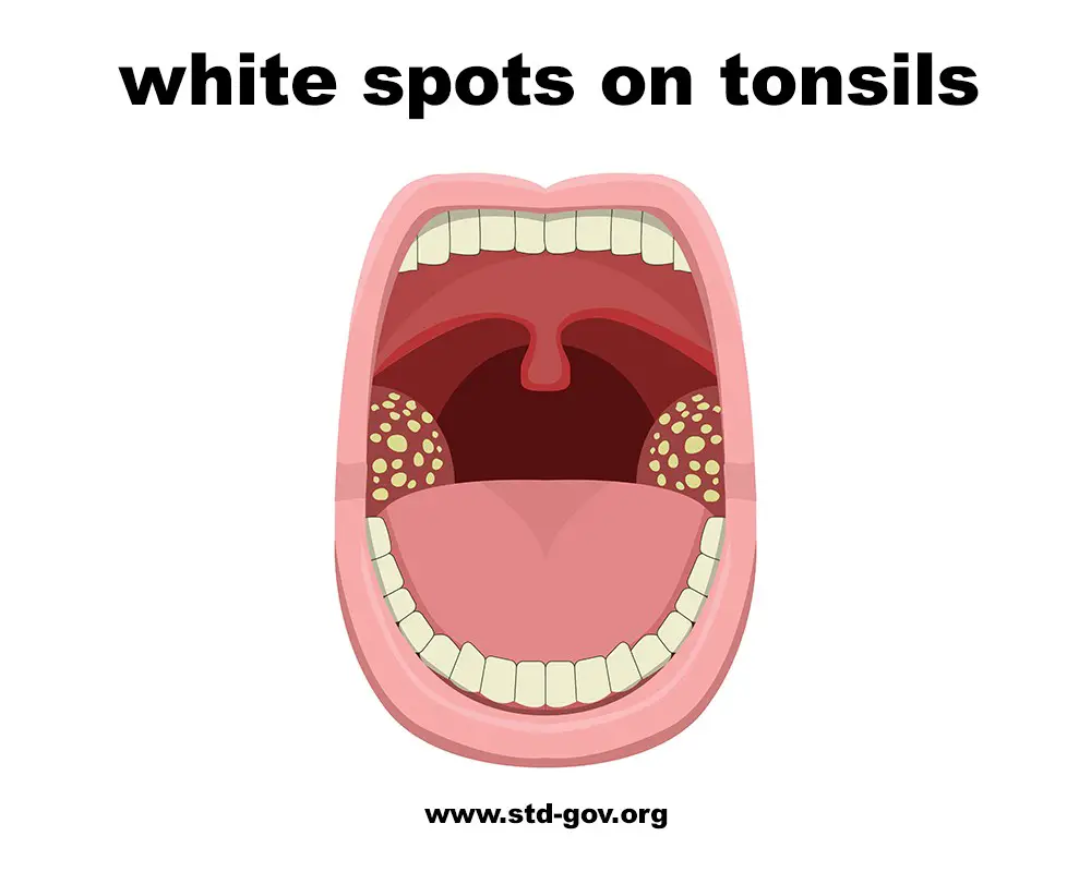 White Spots On Throat Symptoms