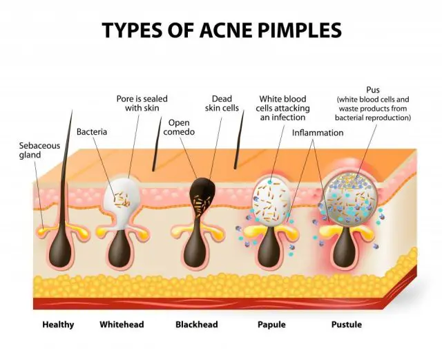 ypes of acne pimples. Healthy skin, Whiteheads and Blackheads, Papules and Pustules