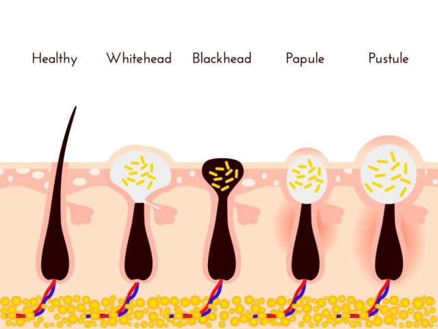 Types of acne pimples