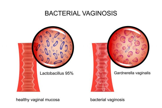 vagina affected by bacterial vaginosis