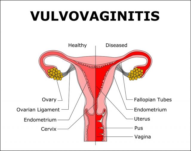 Vulvovaginitis