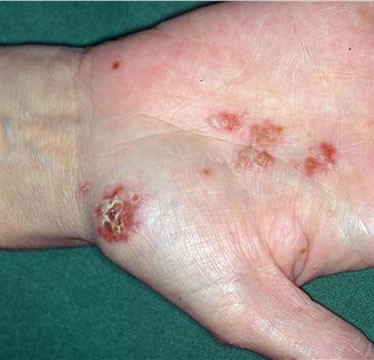 What Is Scabies ? Rash, Treatment, Symptoms, Pictures