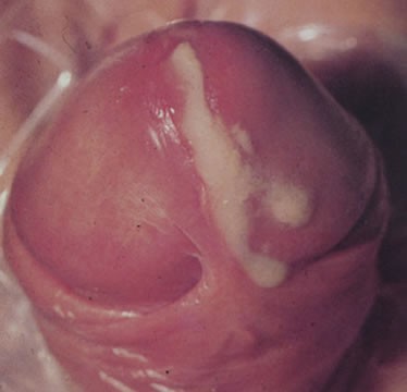 Gonorrhea symptom photo (picture)