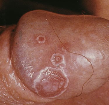 Chlamydia symptom photo (picture)