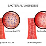 Bacterial Vaginosis (BV)