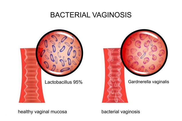 Bacterial Vaginosis (BV)