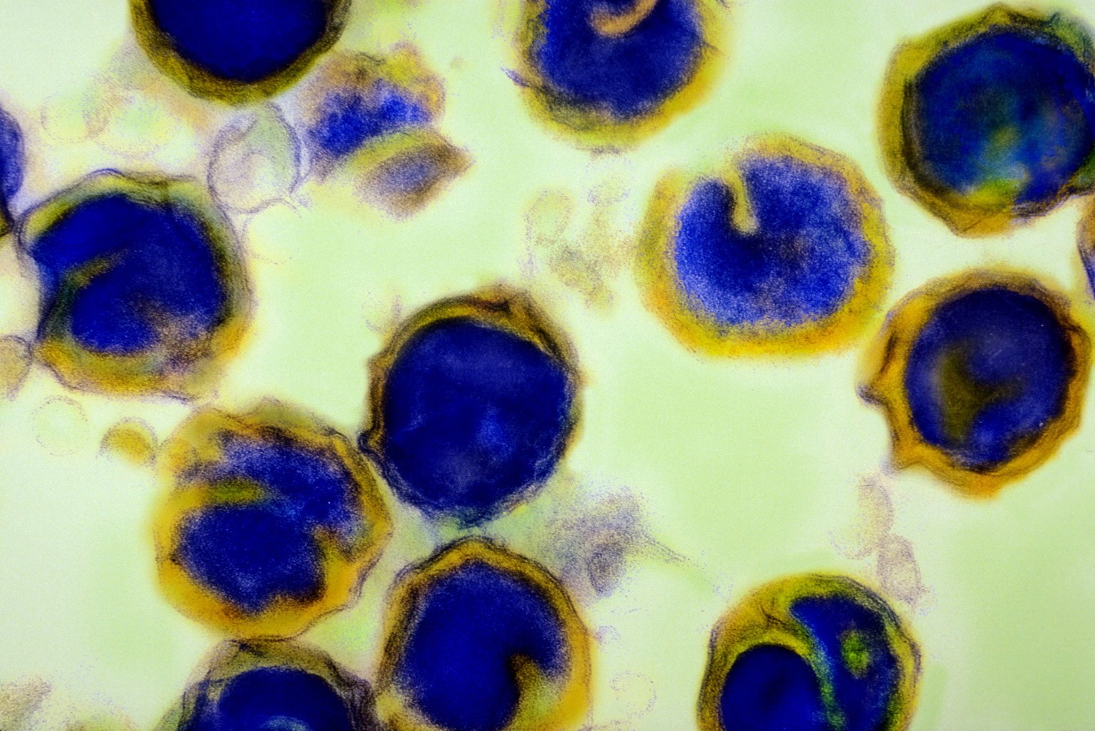 Хламидии 4. Гонорея под микроскопом в мазке.