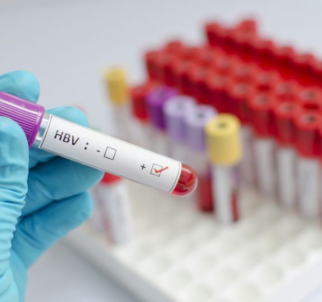 Blood sample with hepatitis B virus (HBV) positive