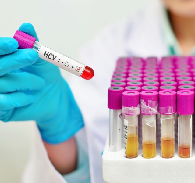 Blood sample positive with hepatitis C virus (HCV)