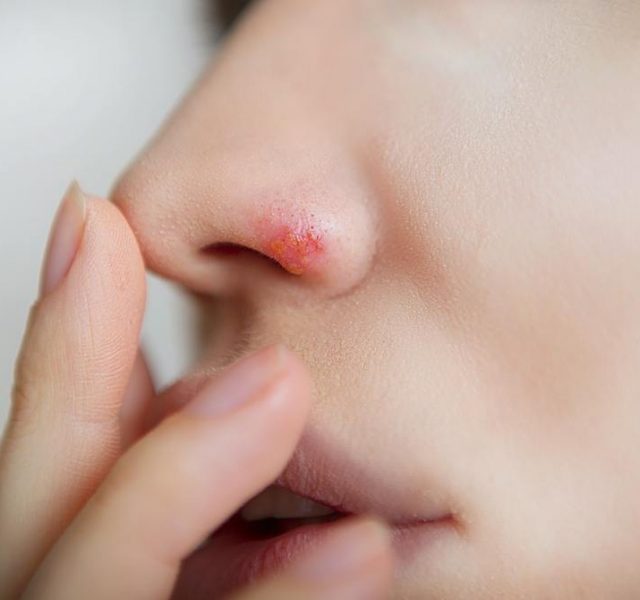 Herpes on the nose