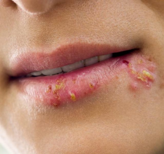 Herpes on the lips of the young woman