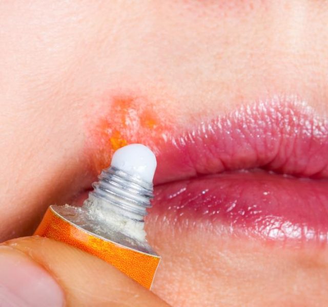 Herpes on the lip close-up macro. Woman lubricates the labial herpes ointment