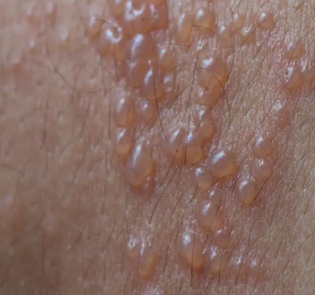 Skin infected Herpes zoster virus