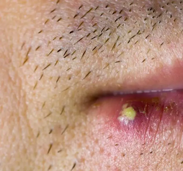 Virus herpes infected on male lip, closeup