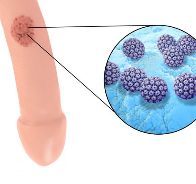Common locations of genital warts, Human papillomavirus HPV lesions in men, and close-up view of HPV. 3D illustration