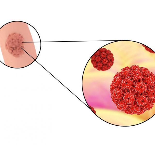 Human papillomavirus HPV lesions in men, genital warts, and close-up view of HPV. 3D illustration