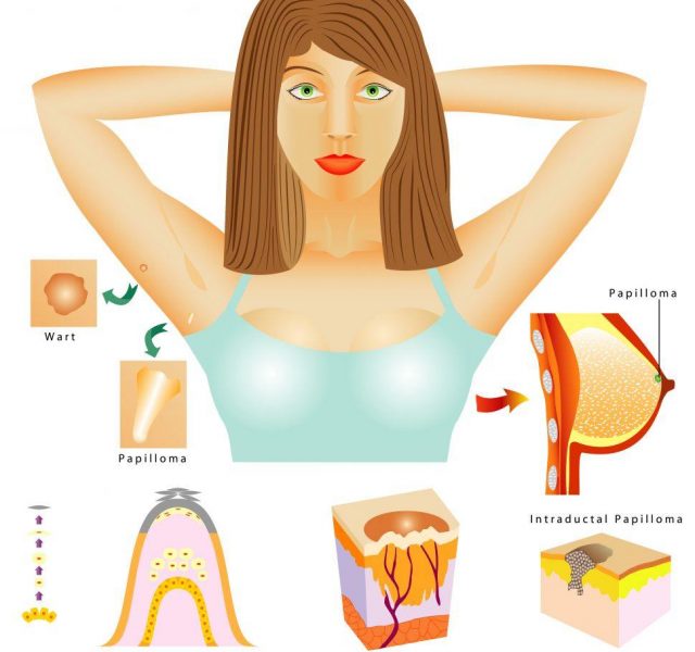 Papilloma. Human papilloma virus (HPV). This HPV is the causative agent of warts and birthmarks