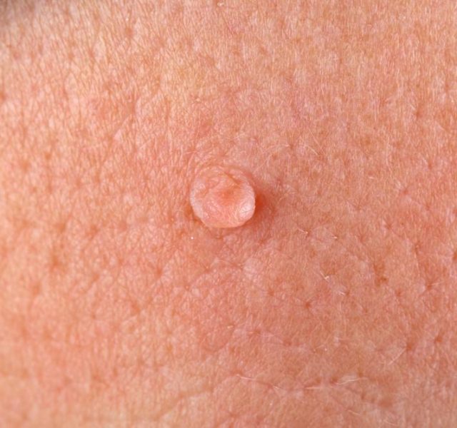 Close up photo of wart on human skin