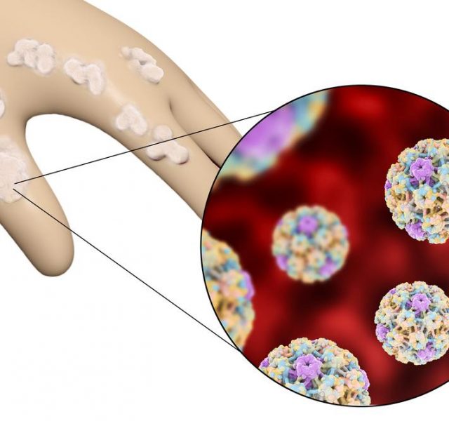 Hand with warts and close-up view of papillomavirus which causes development of warts, 3D illustration