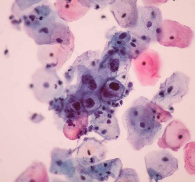 View in microscopic of koilocyte cell criteria of HPV (Human Papilloma virus) infection.Pap smear for woman
