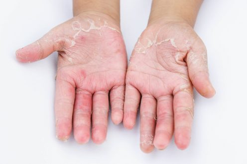 Contact Dermatitis: Vaginal Itching, Burning and Irritation