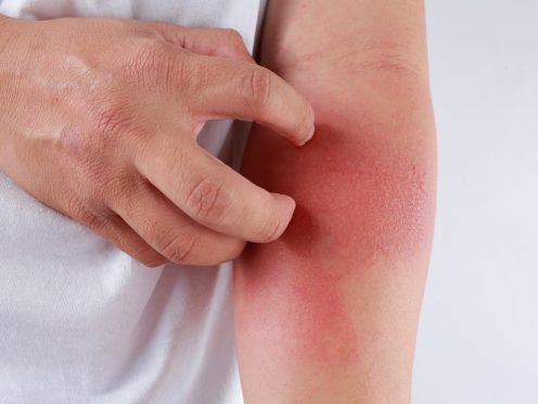Eczema: Vaginal Itching, Burning and Irritation