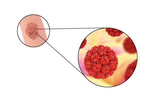 HPV: Vaginal Itching, Burning and Irritation