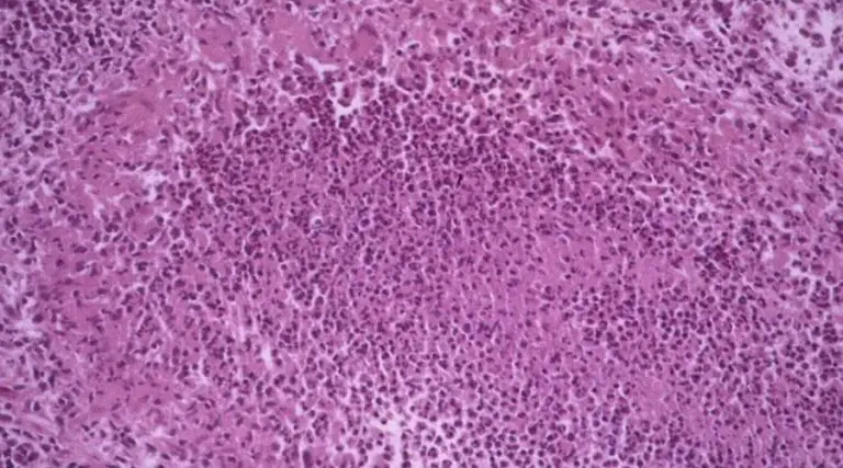 Lymphogranuloma Venereum