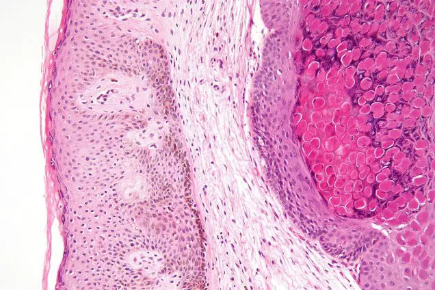 Molluscum Contagiosum