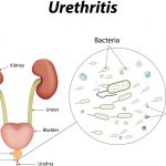 NGU (Non-Gonococcal Urethritis)