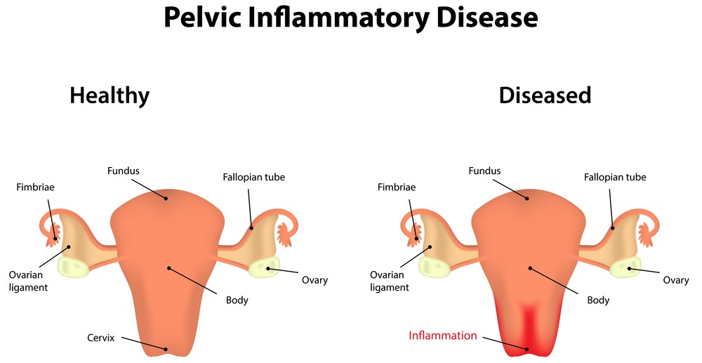 Image result for pelvic inflammatory disease (pid)