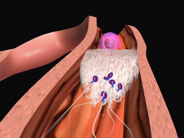 Pelvic Inflammatory Disease