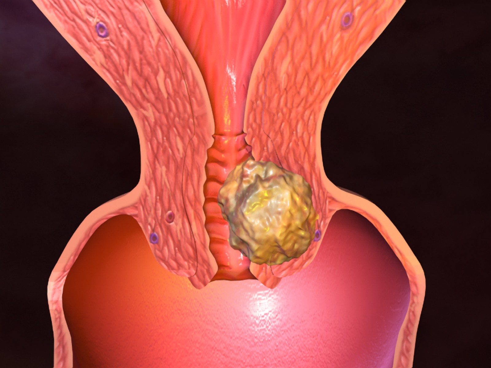 Management of genital Chlamydia trachomatis infection ...