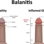 Yeast infection in men (Balanitis)