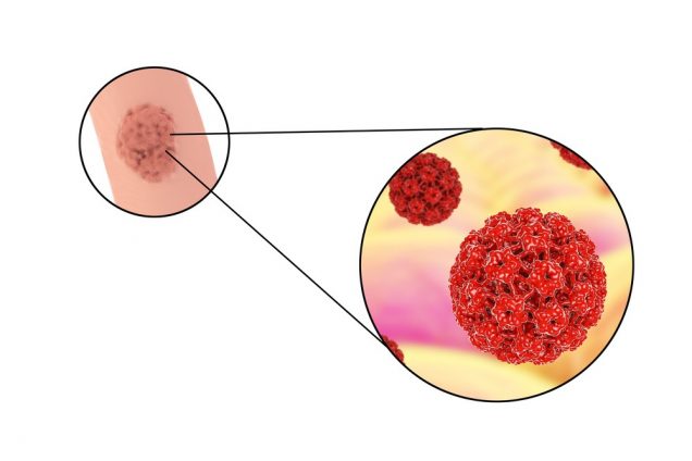 Bumps on Penis: HPV can cause penis bumps