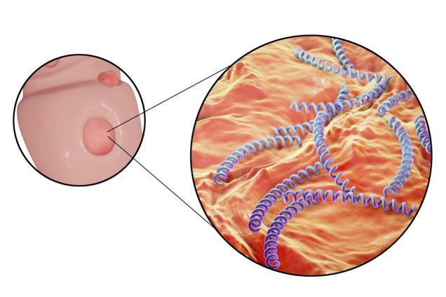 Bumps on Penis: Syphilis