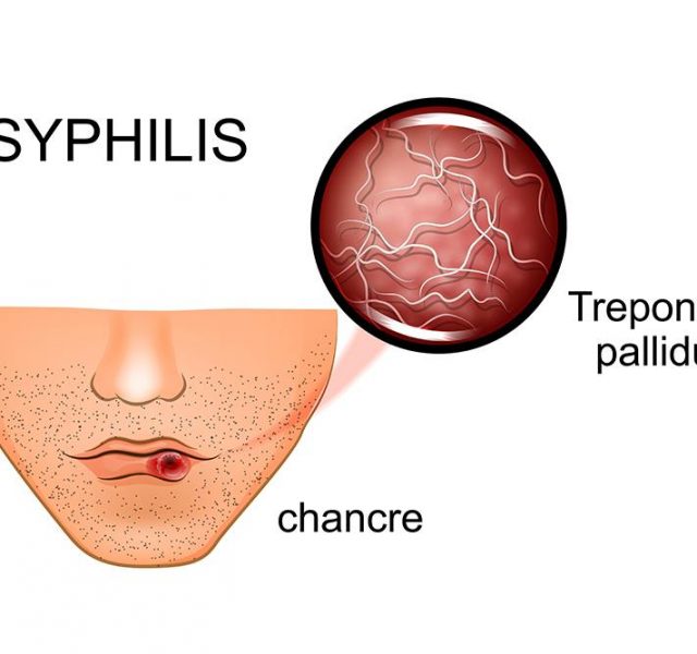 Illustration of syphilis. symptoms and causative agent