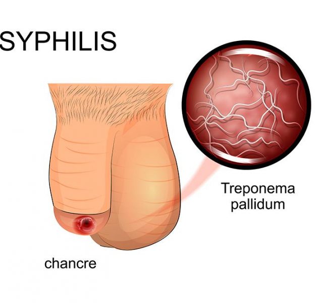 Illustration of symptoms of syphilis - affected penis