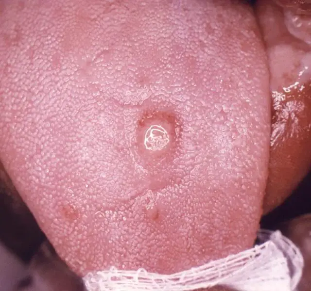 Primary stage syphilis sore